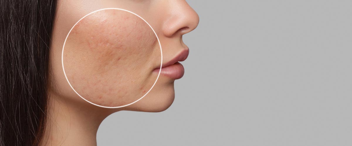 Acne Scars