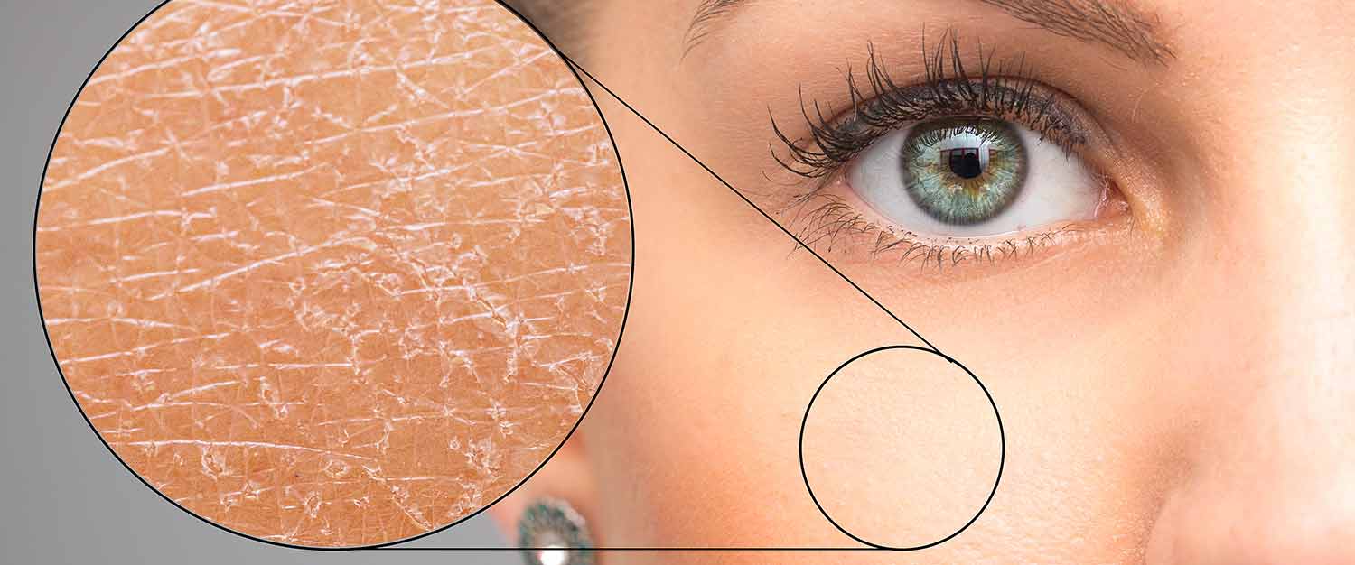 Does Dry Skin Cause Wrinkles?