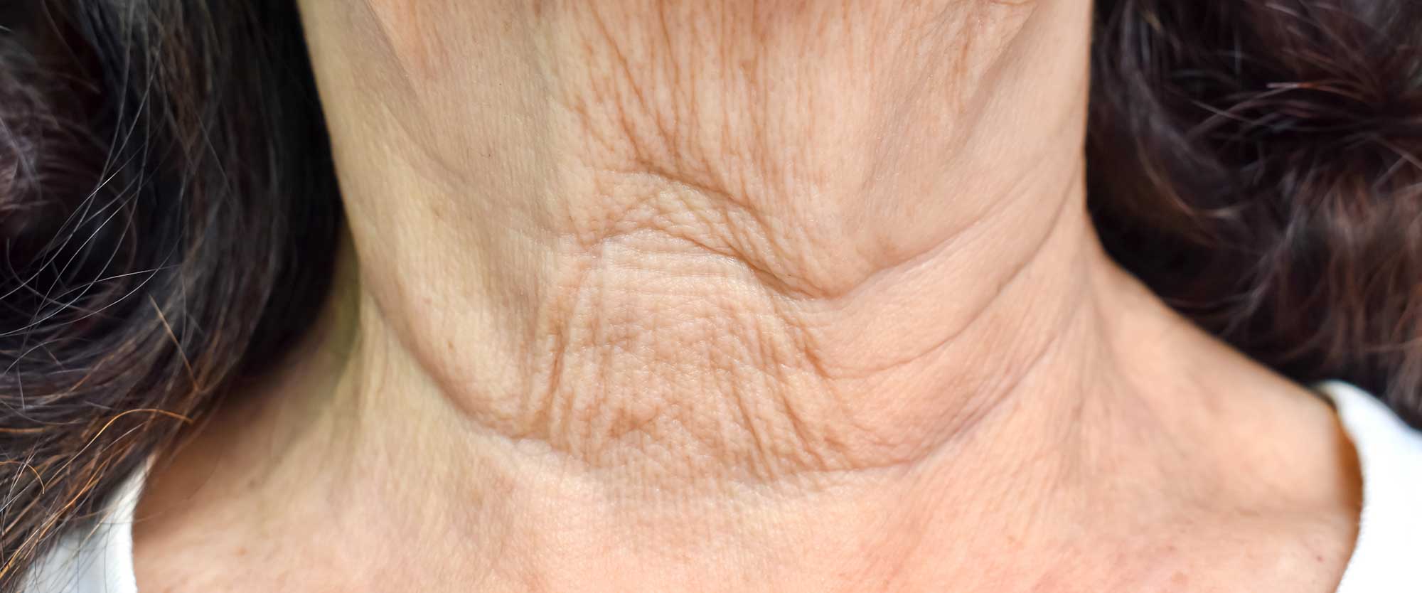 Here’s What You Need to Know About Permanent Elastotic Creases