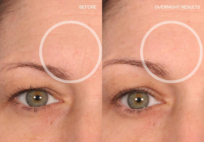 Before and After - Brow