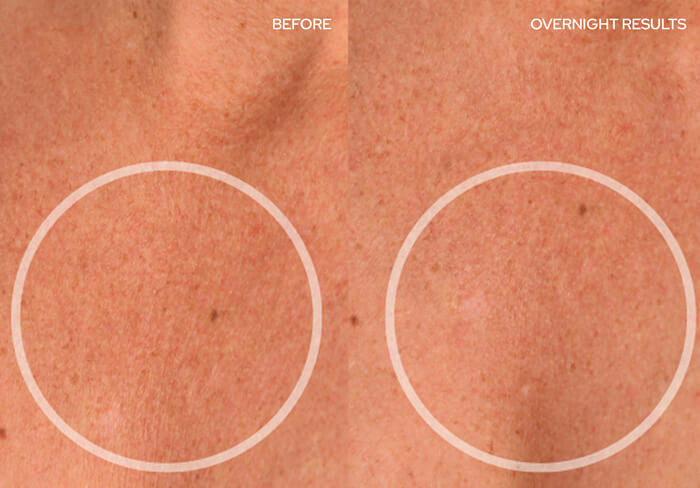 Before and After - Chest