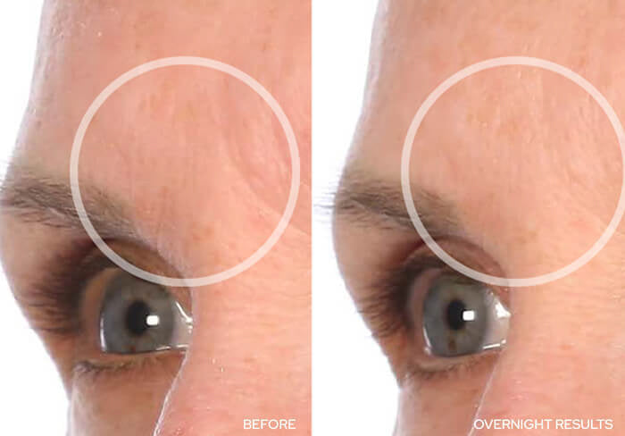 Before and After - Forehead