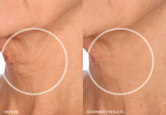 Before and After - NeckLift