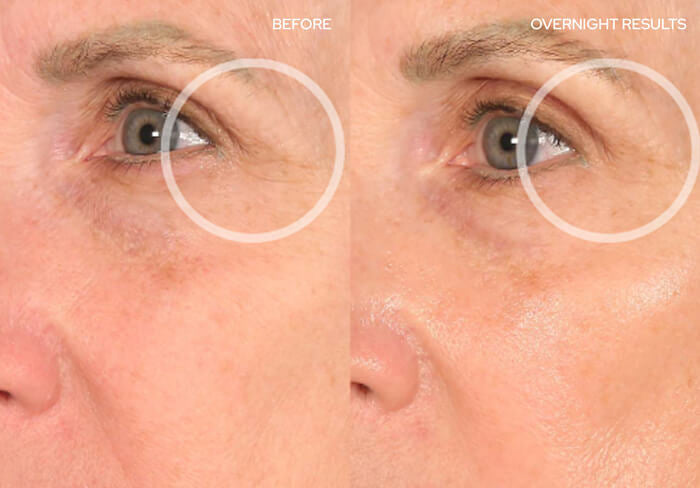 Before and After - SuperEyeLift