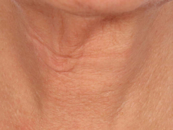 After image