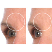 forehead results with silicone patches