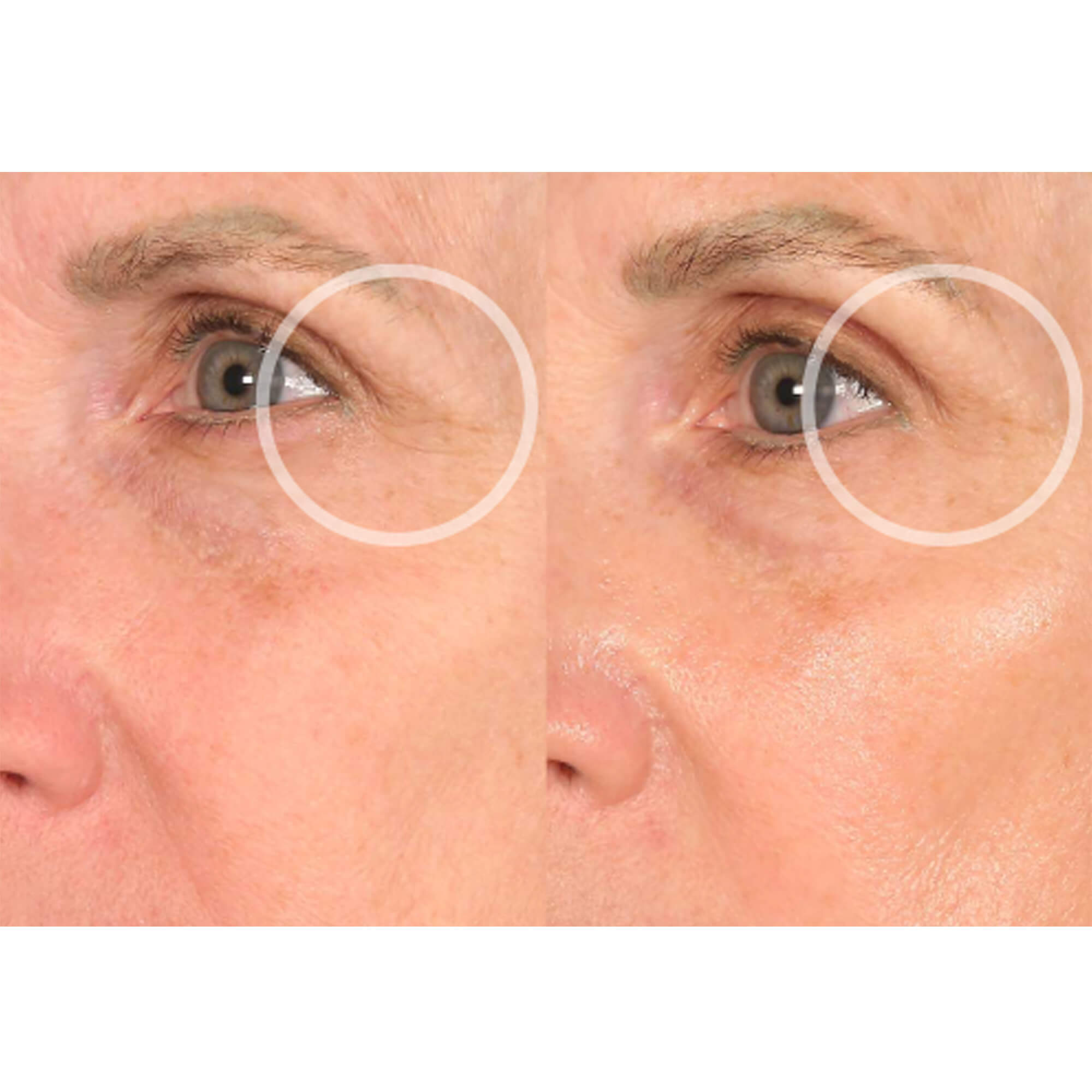 eye results before and after