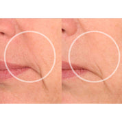 lip wrinkles before and after