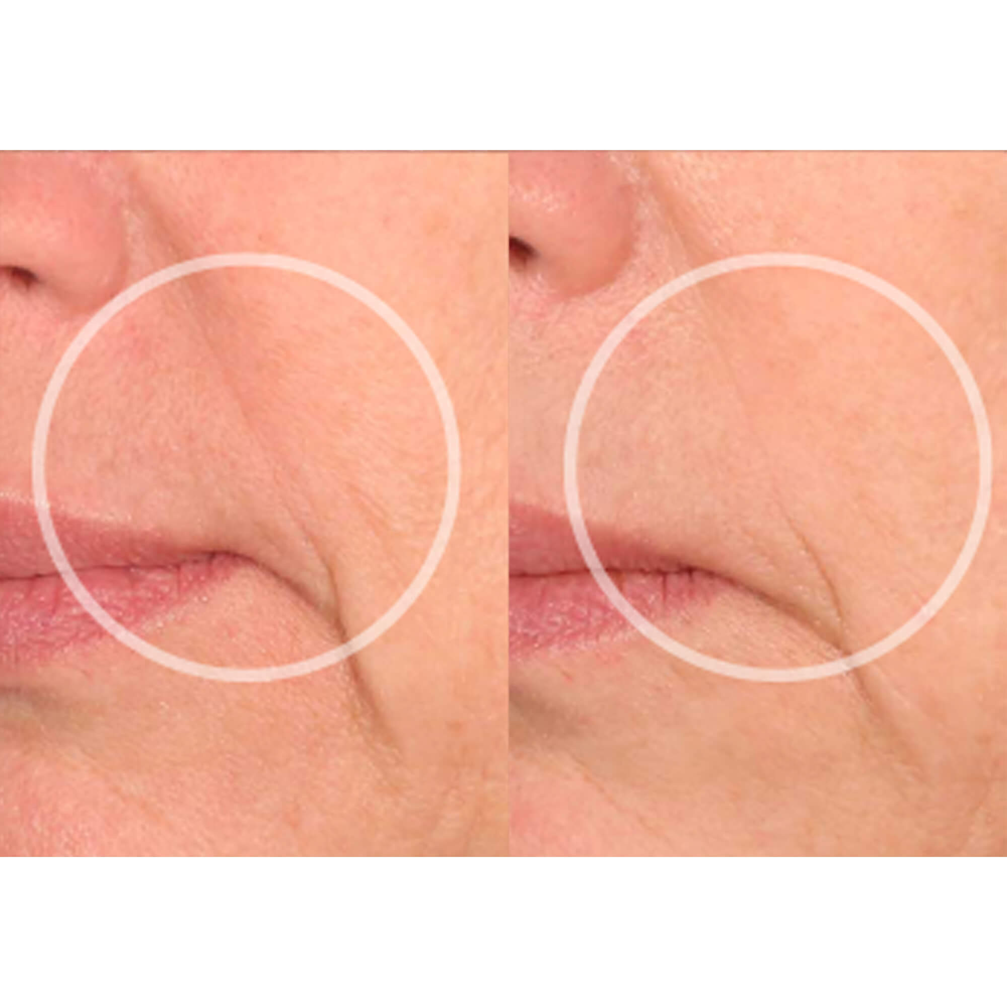 lip wrinkles before and after