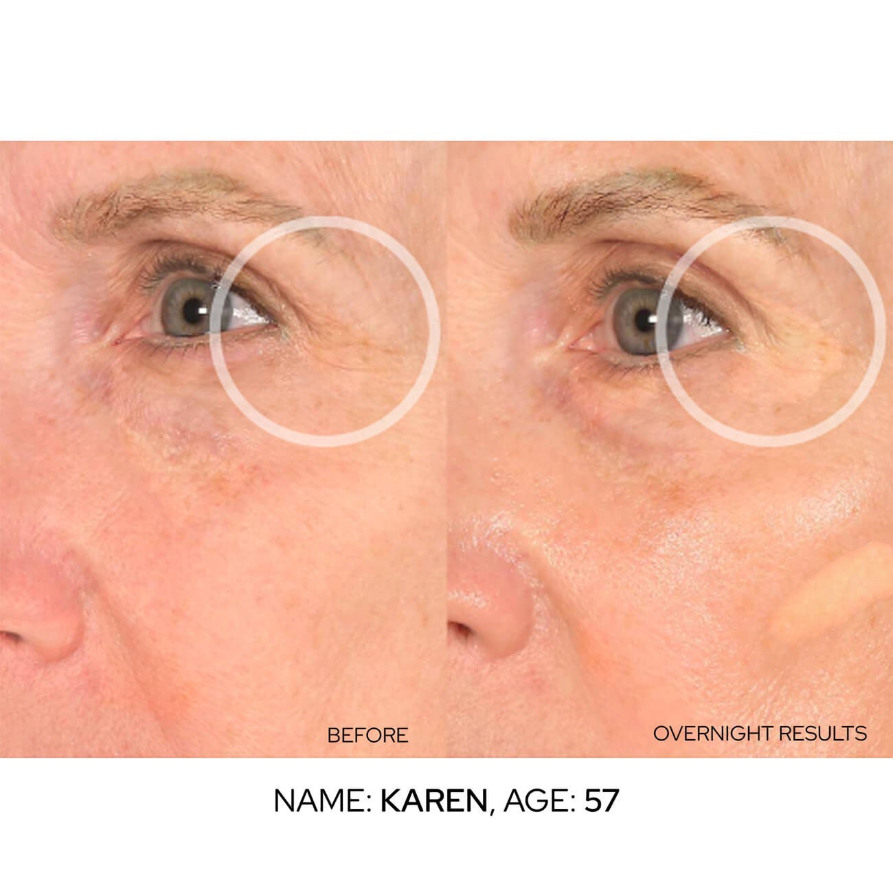 SIO Beauty Eye Hydroseal™ Patches before and after comparison showing smoothed crow's feet and under-eye lines.