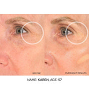 SIO Beauty Eye Hydroseal™ Patches before and after comparison showing smoothed crow's feet and under-eye lines.